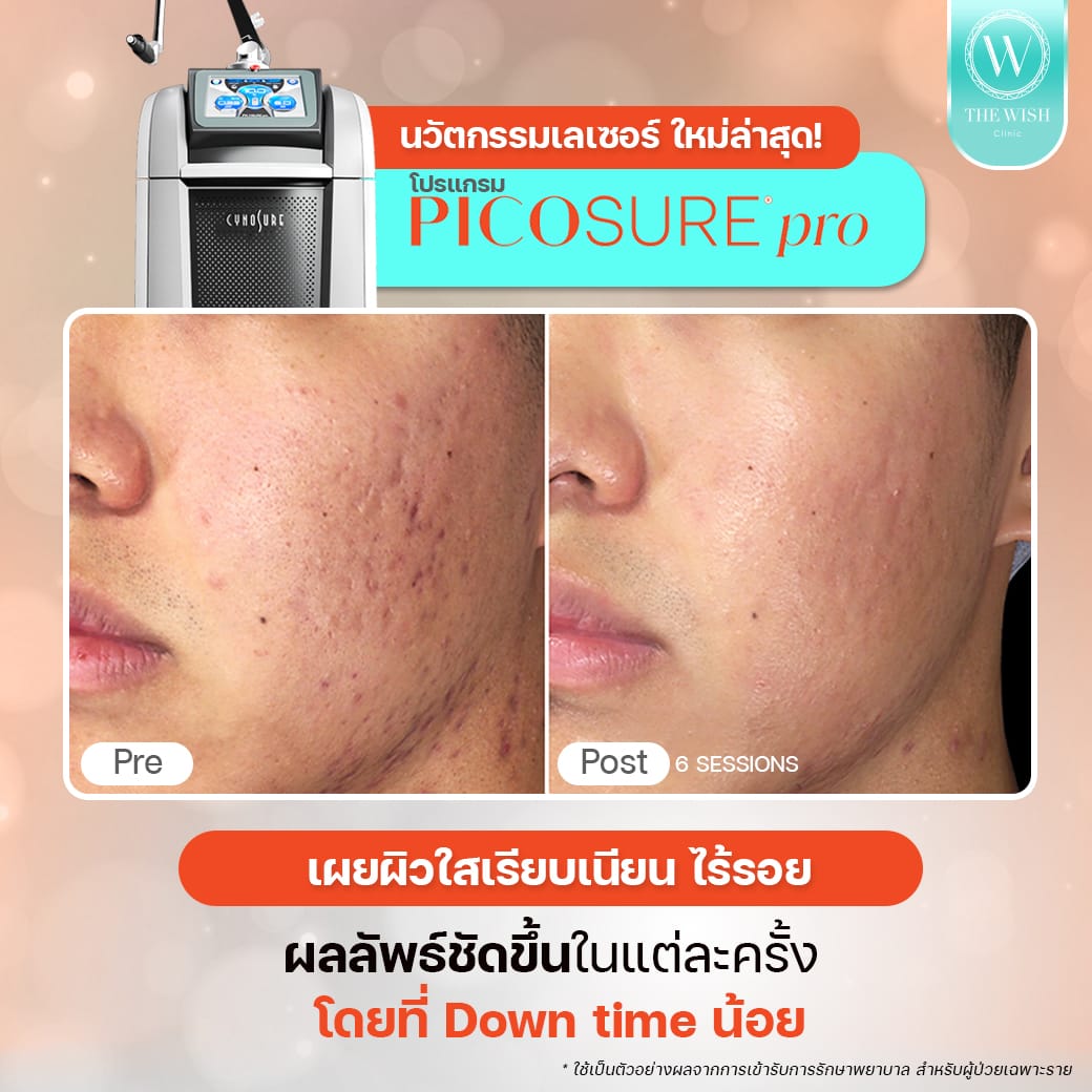 picosure_Acne Scar1